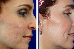 إزالة الندبات بالليزر في دبي وأبو ظبي