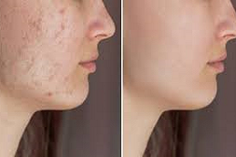 إزالة الندبات بالليزر في دبي وأبو ظبي والشارقة