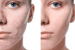 إزالة الندبات بالليزر | تقليل الندبات إزالة الندبات بالليزر في دبي وأبو ظبي والشارقة والعين