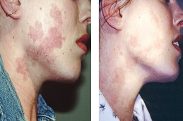 إزالة الوحمات بالليزر في دبي وأبو ظبي والشارقة والعين