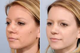 إزالة الوحمات بالليزر في دبي وأبو ظبي والشارقة