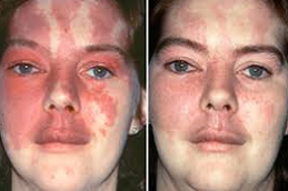 إزالة الوحمات بالليزر في دبي وأبو ظبي