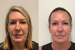 الوخز بالإبر الدقيقة RF الجزئي الإبر الدقيقة بالترددات الراديوية في دبي وأبو ظبي والشارقة والعين