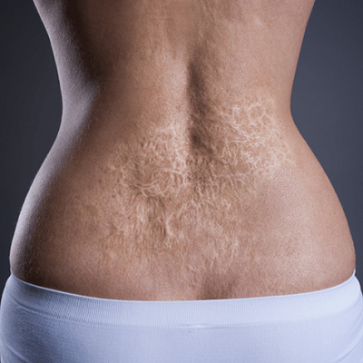 الجراحة الترميمية للحروق في دبي وأبو ظبي والشارقة والعين