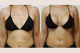 حقن الماكرولين في والشارق