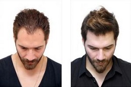 زراعة الشعر بالاقتطاف في دبي