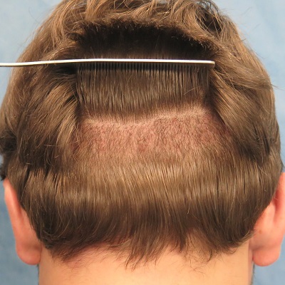 زراعة الشعر بالاقتطاف في دبي وأبو ظبي والشارقة والعين