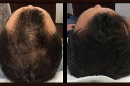 زراعة الشعر بالخلايا الجذعية زراعة الشعر بالخلايا الجذعية في أبو ظبي