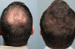 زراعة الشعر بالخلايا الجذعية في دبي