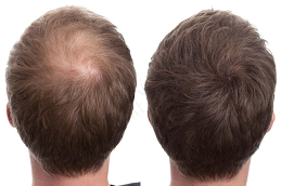 زراعة الشعر بالخلايا الجذعية زراعة الشعر بالخلايا الجذعية في والشارق