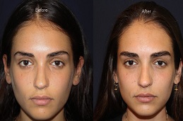 زراعة شعر الحاجب في أبو ظبي