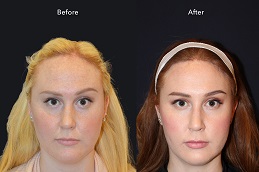 زراعة شعر الحاجب في والشارق