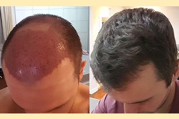 زراعة وحدة بصيلات الشعر في والشارق