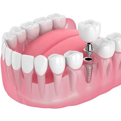 زرع الأسنان في دبي وأبو ظبي والشارقة والعين