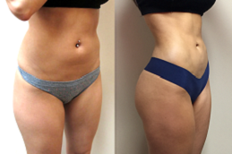 شفط الدهون دبي وأبو ظبي