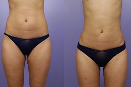 شفط الدهون دبي وأبو ظبي والشارقة