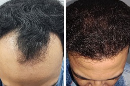 علاج GFC للشعر في أبو ظبي