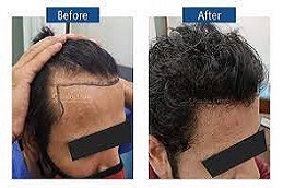 علاج GFC للشعر في دبي