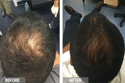 علاج GFC للشعر في والشارق