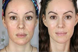 علاج تجديد الجلد في دبي وأبو ظبي