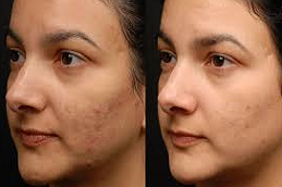 علاج تجديد الجلد في دبي وأبو ظبي والشارقة