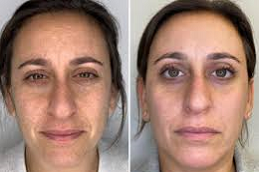 علاج تجديد الجلد في دبي وأبو ظبي والشارقة