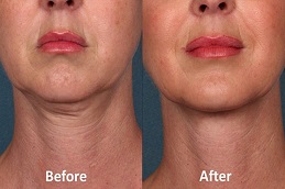 علاج نفرتيتي في أبو ظبي