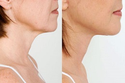 علاج نفرتيتي في دبي