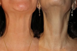 علاج نفرتيتي في والشارق