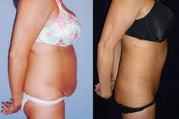 عملية نحت الجسم غير الجراحية في دبي وأبو ظبي والشارقة والعين