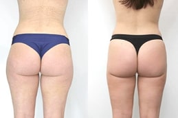 حقن الدهون / نقل الدهون نقل الدهون في والشارق