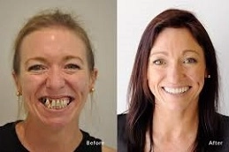 زراعة-اسنان-في-ابو ظبي-العين.