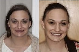 زراعة الاسنان في ابوظبي