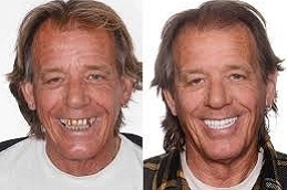 زرع الأسنان