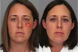 الجراحة الترميمية للحروق في أبو ظبي