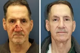 الجراحة الترميمية للحروق في دبي