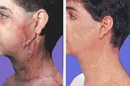 الجراحة الترميمية للحروق في والشارق