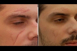 تنقيح الندبة الجراحية في دبي
