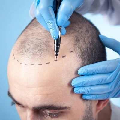 زراعة الشعر الهجين زراعة الشعر الهجين في دبي وأبو ظبي والشارقة والعين