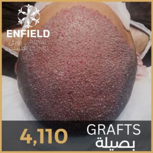 صورة زراعة الشعر