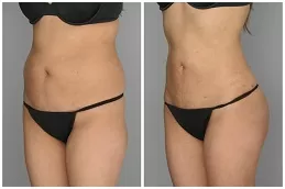 علاج ليبوماتيك (نحت الجسم) في أبو ظبي