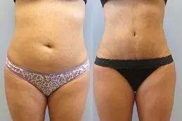 علاج ليبوماتيك (نحت الجسم) في دبي