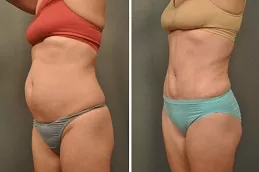 علاج ليبوماتيك (نحت الجسم) في والشارق