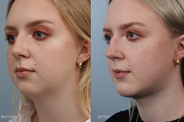 عملية تكبير الذقن في أبو ظبي