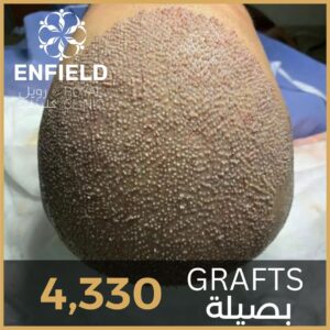 قبل وبعد زراعة الشعر