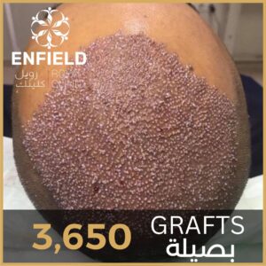 نتائج زراعة الشعر