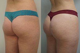 Before-After-Buttock-Lift-in-Abu-Dhabi-Al-Ain