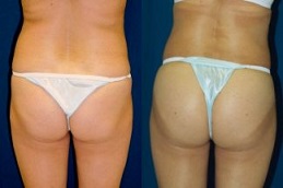 Before-After-French-butt-reshaping-in-Abu-Dhabi-