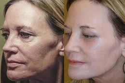 Best-Fotona-Twin-Light-Fractional-Rejuvenation-in-Abu-Dhabi-UAE