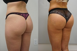 Buttock-Lift-in-Abu-Dhabi-Al-Ain-Before-After